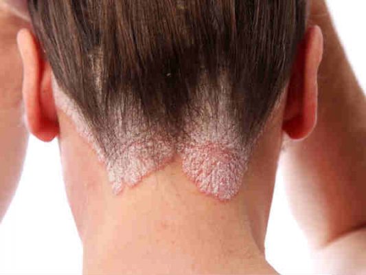 Cách Trị Gàu Tại Nhà Hiệu Quả Nhất