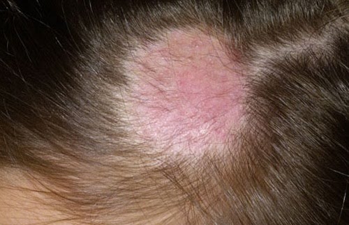 Nấm da đầu có gây rụng tóc không