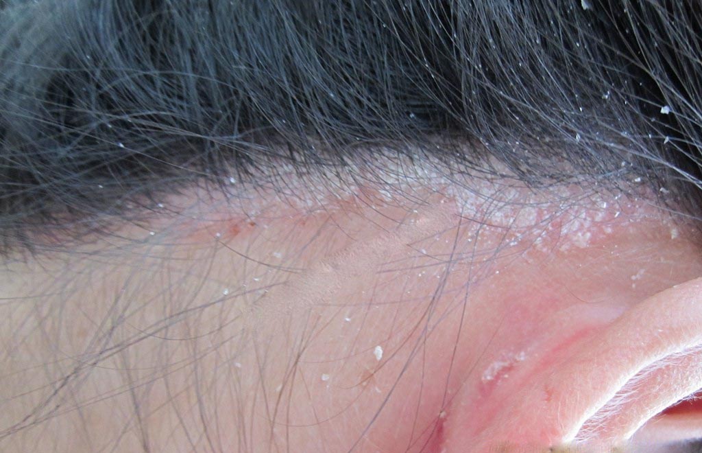 hướng dẫn cách trị gàu đơn giản